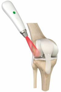 Lasertherapie am Knie